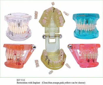 1 шт. Модель зубных имплантатов при заболеваниях зубов с реставрационным мостовидным протезом Стоматолога для обучения врачей-стоматологов